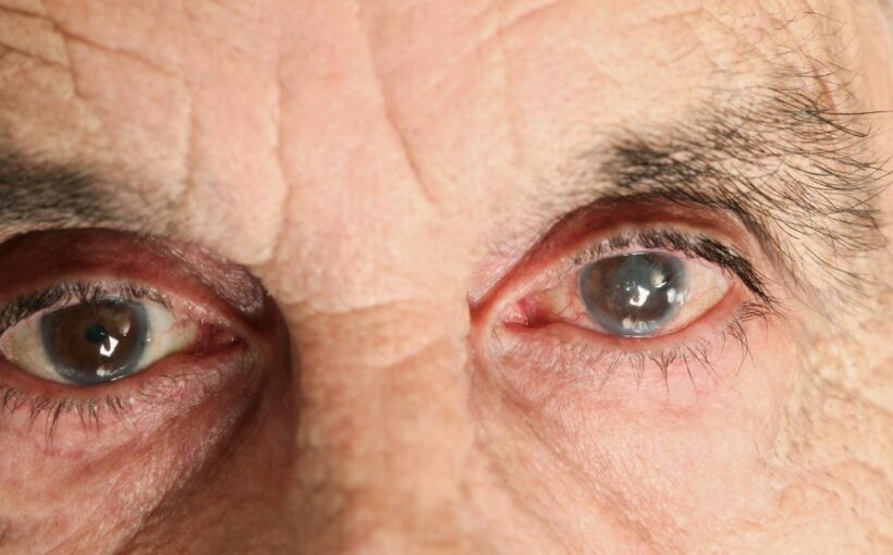Recovery and Beyond: Post-Op Care Tips for Successful Cataract Surgery